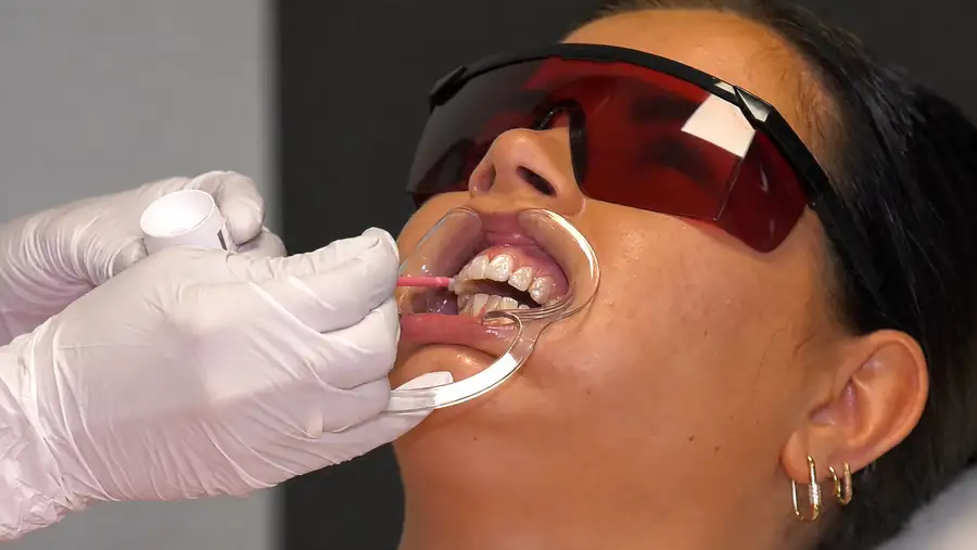 Professional application of whitening gel during a teeth whitening treatment